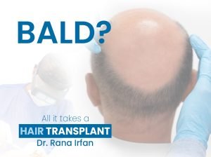 Hair Transplant service in Islamabad