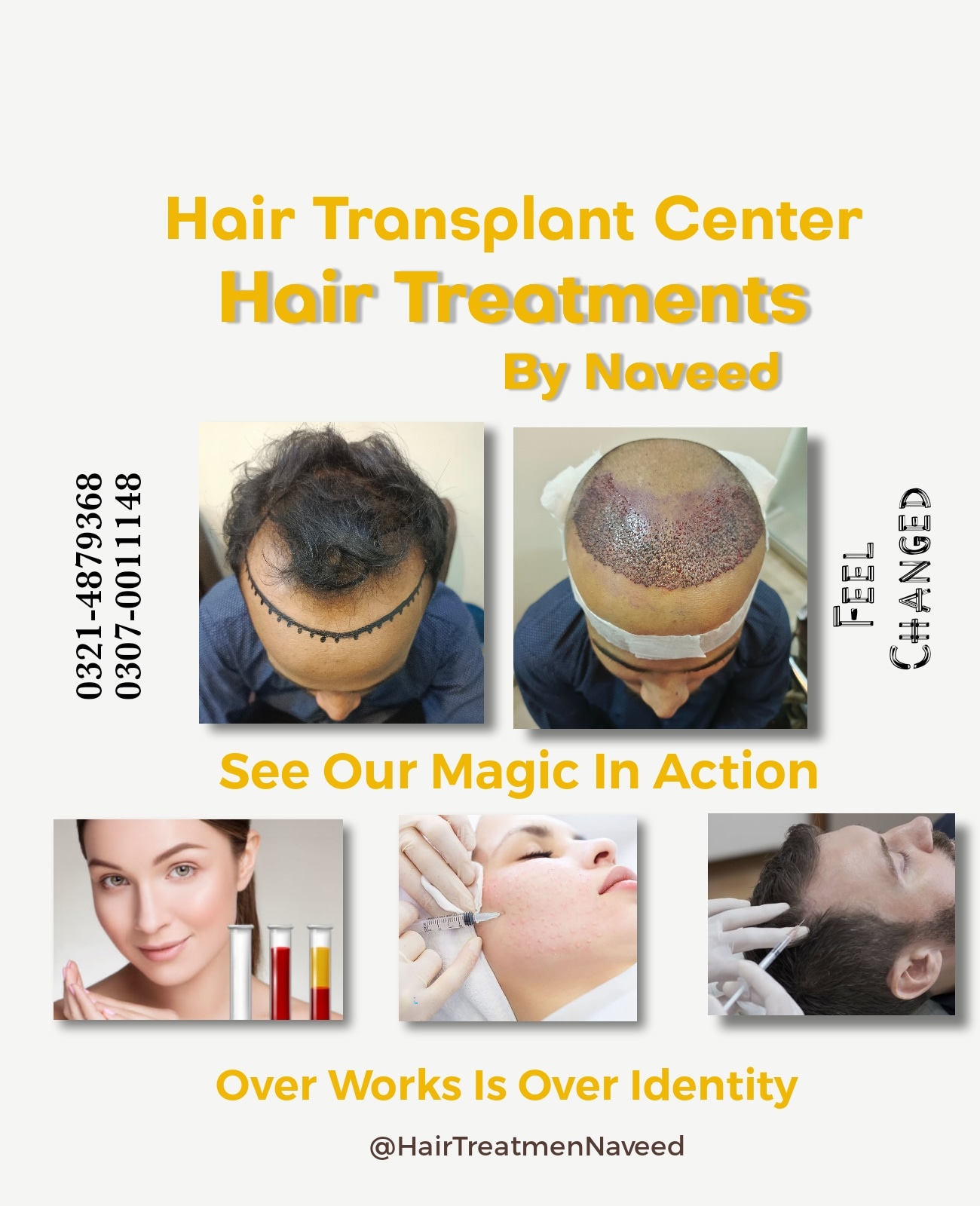 Hair Patch Hair Wig Hair Cap Hair Extension