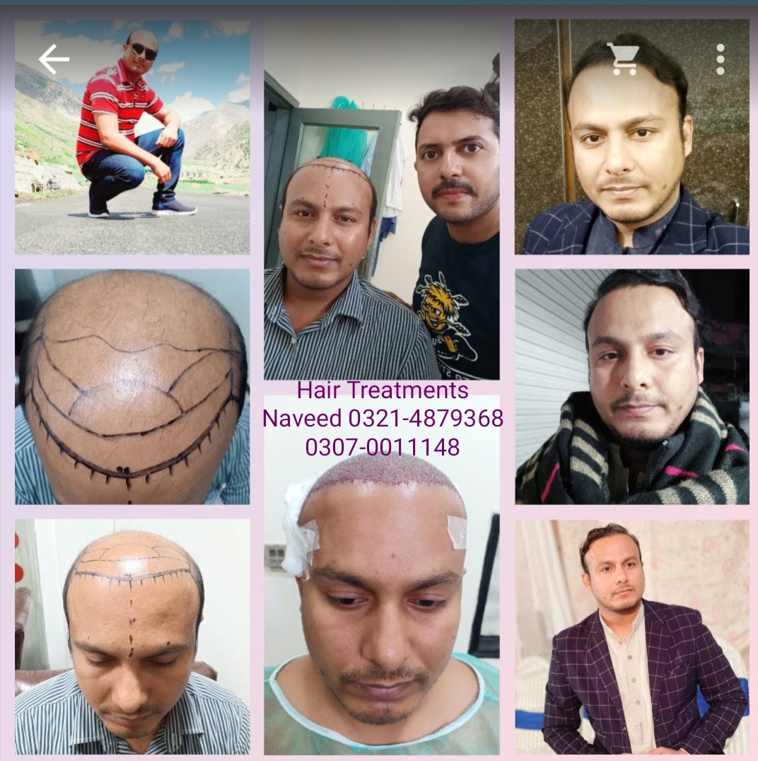 Hair Patch Hair Wig Hair Cap Hair Extension