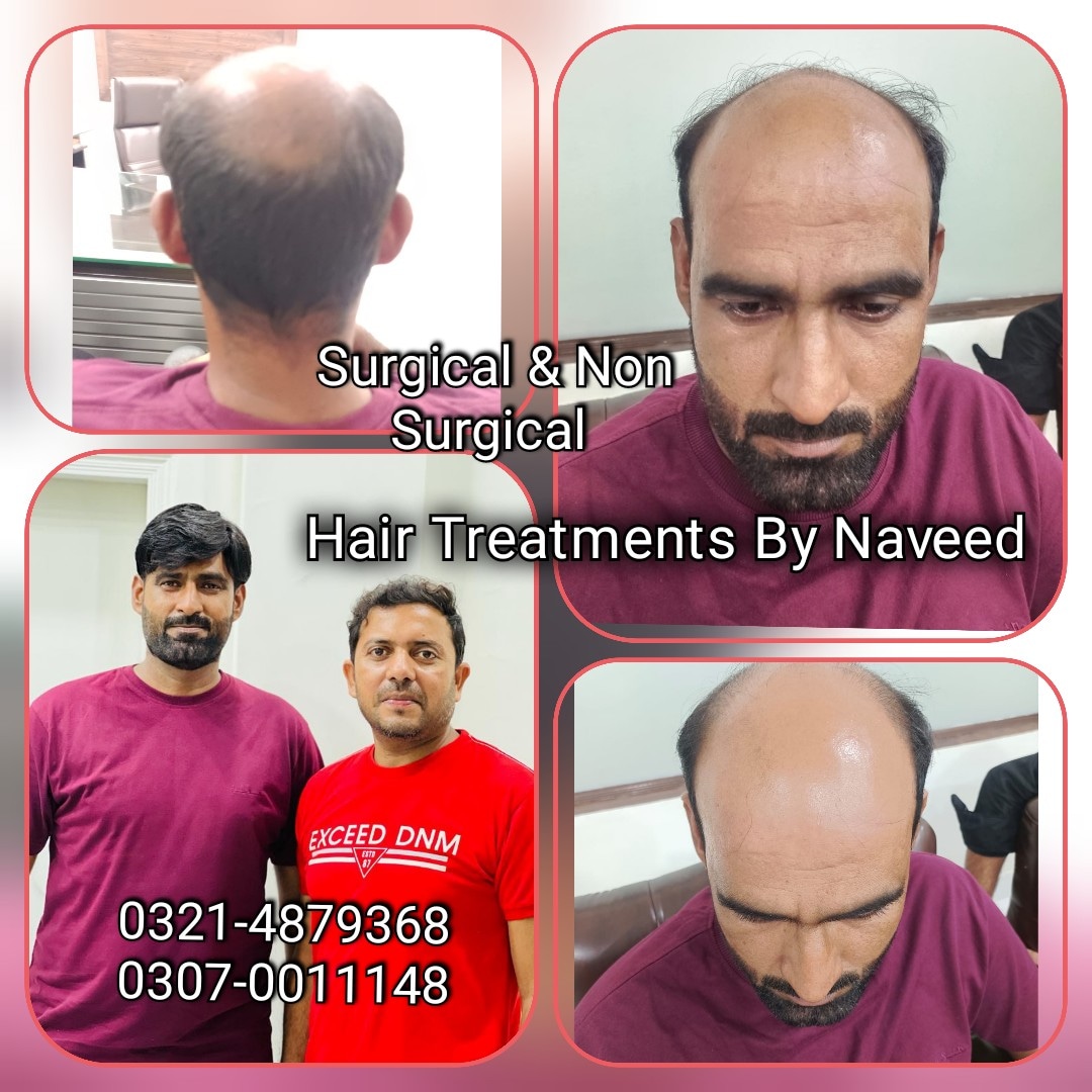 Hair Patch Hair Wig Hair Cap Hair Extension