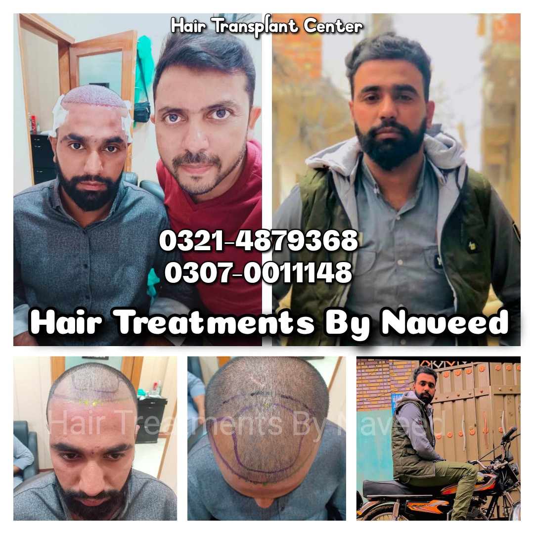 Hair Patch Hair Wig Hair Cap Hair Extension