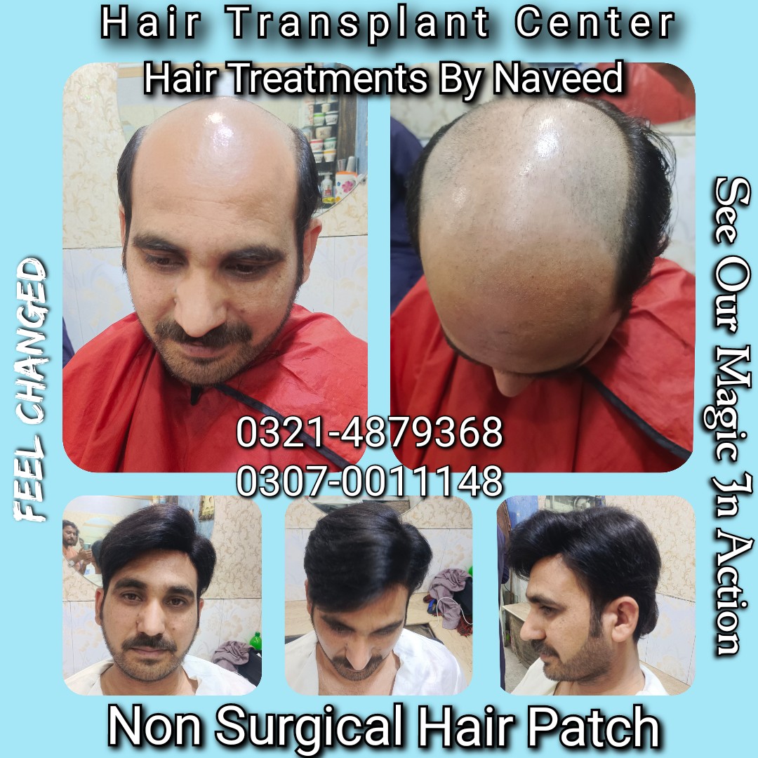 Hair Patch Hair Wig Hair Cap Hair Extension